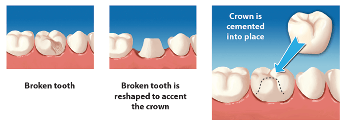 dental-crown