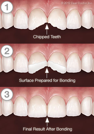 tooth-bonding-series