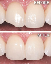 tooth-bonding-before-after