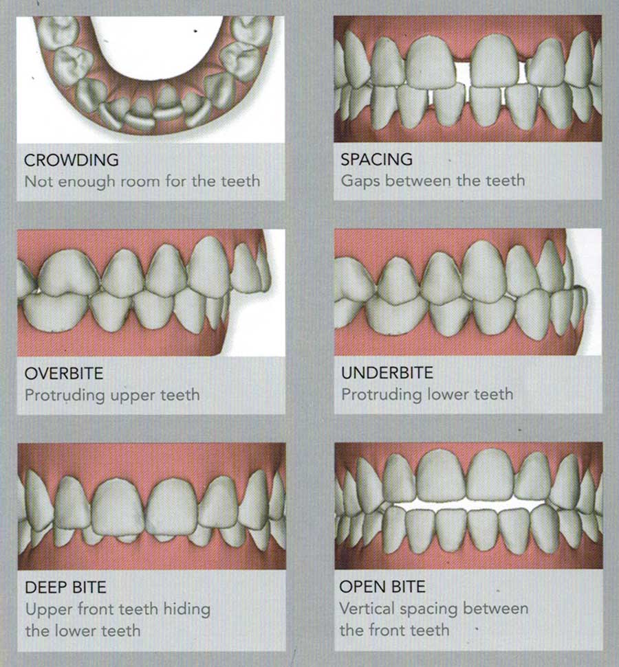 Invisalign A Better Smile Oklahoma